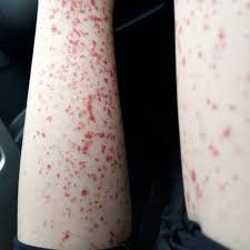 Protein tempe dapat digunakan sebagai pelengkap atau pengganti protein hewan yang lebih mahal. Muncul Bintik Merah Alma Ternyata Alami Pembuluh Darah Pecah Health Liputan6 Com