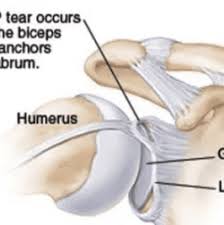 It contributes to shoulder stability and, when torn, can lead to partial or complete shoulder dislocation. Shoulder Labral Tear Relevant Anatomy And Function Ashvin K Dewan Md Orthopedic Surgeon