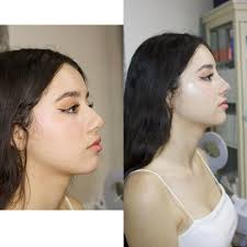 ARMONIZACIÓN FACIAL. Nuestra Representante Nacional en manos de su amigo el  Dr. Jesus Magallanes