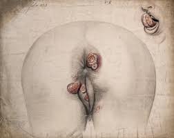 File:The diseased tissue around the anus and genitals of a woman, Wellcome  V0009921.jpg - Wikimedia Commons