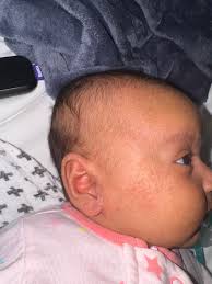 Image result for yellow scabs on the face in children