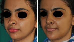 How much does it cost to get a nose job. Rhinoplasty Kerala India Cosmetic Nose Surgery Cost Ernakulam