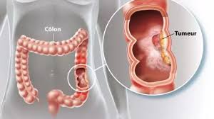 Cancer du côlon : symptôme, stade, espérance de vie | Ramsay Santé