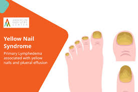 Image result for Yellow nail syndrome feet