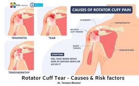 Image result for Rotator cuff tear
