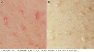 How can i prevent it in the future? Heat Rash Symptoms And Causes Mayo Clinic