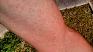 Most people infected with west nile virus either don't develop signs or symptoms or have only minor ones, such as a fever and mild headache. Rashes With Viruses Symptoms Causes Pictures And Treatment