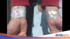 Obat sakit gigi yang sering digunakan dan bisa didapatkan di apotek berikutnya adalah ponstan. Viral Bawang Putih Ditempel Di Tangan Obati Sakit Gigi Ini Kata Dokter