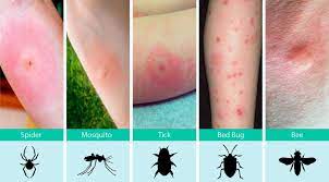 Diagnosis Related Of Allergies To Bites And Stings Alleapp