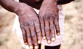 Monkeypox is an infectious disease caused by the monkeypox virus that can occur in certain animals including humans. The Monkeypox Virus Returns To Nigeria Via News