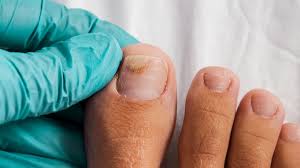 Image result for Pitting nails feet