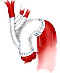 Aortic Aneurysm Surgery Aortic Aneurysm Aneurysm Surgery