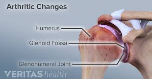 Learn vocabulary, terms and more with flashcards, games and other study tools. What Is Shoulder Osteoarthritis Glenohumeral Arthritis