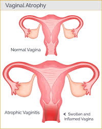 Image result for Atrophic Vaginitis