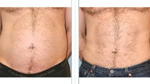 Laser Lipo Vs Coolsculpting