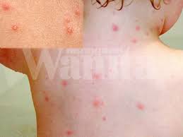 | medically reviewed by chandani dezure, m.d., faap, pediatric hospitalist. Tolonglah Jangan Asingkan Anak Anak Daripada Kanak Kanak Lain Yang Kena Cacar Air Lagi Lagi Anak Perempuan Mingguan Wanita