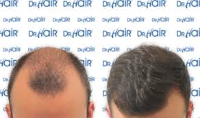 Dr Hair Hair Transplantation Turkey Sac Ekimi Transplante Capilar Trassiz Sac Ekimi Sac
