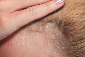 To treat scalp psoriasis, you must loosen and remove scale. Scalp Psoriasis Symptoms Causes And Treatment