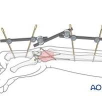 Joint-spanning external fixation (temporary) for Partial ...