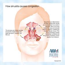 Image result for Intubation Associated Sinusitis
