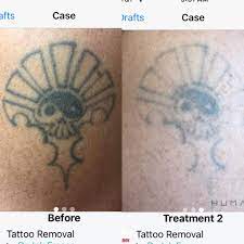 A strip of skin, resulting in less scarring and a higher success rate. Columbus Tattoo Removal By Dr Ink Eraser Facebook