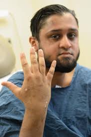 Mount Sinai dermatologist leading breakthrough treatment of severe eczema