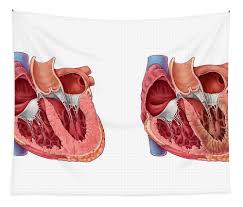 Image result for Restrictive Cardiomyopathy