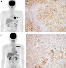 There has been extensive research on the utility of pet for sclc in terms of improved staging, restaging. 2 Deoxy 2 Fluorine 18 Fluoro D Glucose Uptake On Positron Emission Tomography Is Associated With Programmed Death Ligand 1 Expression In Patients With Pulmonary Adenocarcinoma European Journal Of Cancer