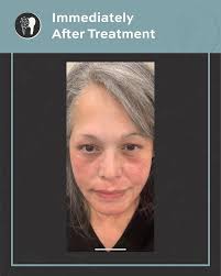 EndyMed USA 🇺🇸