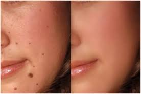 Trị nốt ruồi