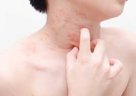 Get the real story on peanut allergies, gluten intolerance, and more. Food Allergy Symptoms Northbrook Allergies In Il Allergist Lake Zurich 60124