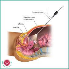 Some symptoms include pelvic pain, heavy periods, pain. Endometriosi Archivi Luigi Fasolino