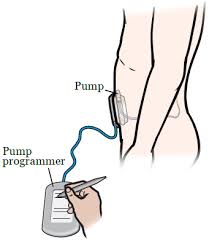 Image result for Intrathecal Pump