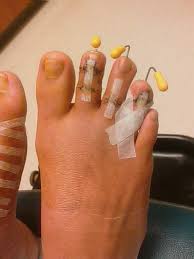 My Toe Shortening Surgery Hammer Toe Surgery Surgery Foot Surgery