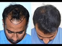 Best Hair Transplant clinics in Jaipur
