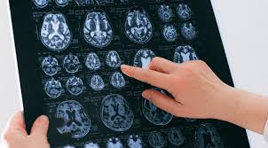 Image result for Thalamic Stimulation