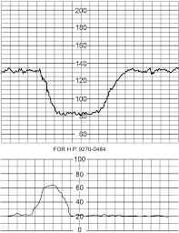 Image result for Late Deceleration