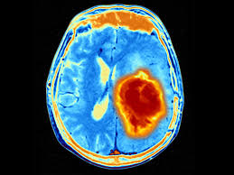 How common are brain tumors? Uab Developed Viral Immunotherapy For Pediatric Brain Tumors Shows Promise News Uab