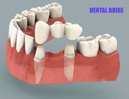 We did not find results for: 3 Jenis Gigi Palsu Permanent Klinik Pergigian Erfa Facebook