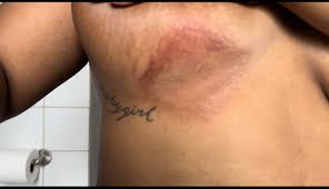 Image result for Candidiasis under breasts