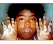 File:Acrofacial Vitiligo.png