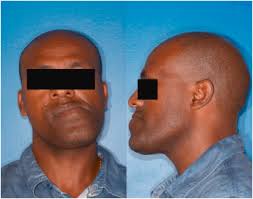 Image result for Jaw Dislocation