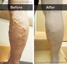 Venaseal A Fast Comfortable Vein Treatment Advanced Vein Therapy