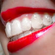 All clearcorrect braces are manufactured in texas and shipped out to dentists in the us, the uk, and australia. Invisalign Pearland Tx Clear Braces Cosmetic Dentist
