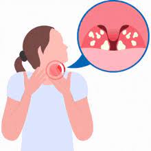 Tonsils GIFs | Tenor
