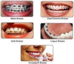Choosing Right Type Of Braces Metal Braces Teeth Braces Dental Braces