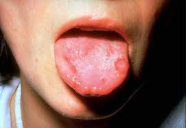 Tentang flu singapur flu singapure atau biasa dikenal juga dengan penyakit kaki, tangan, dan mulut ( ktm ) merupakan infeksi menular yang disebabkan oleh virus. Apa Yang Ibubapa Kena Tahu Mengenai Penyakit Hfmd