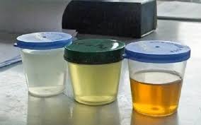 Ini punca sebenar warna air mani berubah jadi kuning. Ramai Tidak Tahu Warna Air Kencing Menggambarkan Kesihatan Anda