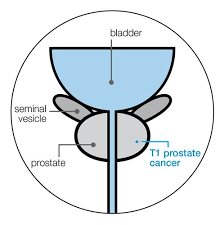 Image result for Prostate Cancer Staging