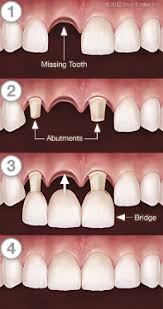 Harga gigi palsu permanen bridge umumnya ditetapkan per biji. Pakai Retainer Dan Gigi Palsu